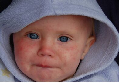 La reparición del sarampión en España pone en alerta a los pediatras La reparición del sarampión en España pone en alerta a los pediatras