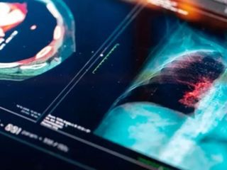 Qué es el adenocarcinoma pulmonar que sufre el Papa: así evoluciona el tumor maligno de pulmón más frecuente Qué es el adenocarcinoma pulmonar que sufre el Papa: así evoluciona el tumor maligno de pulmón más frecuente